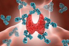 hashimoto's is an autoimmune condition that may go undetected