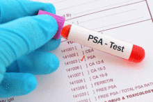 PSA screening