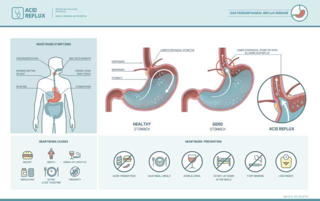 how acid reflux causes heartburn