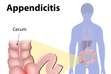 appendicitis symptoms