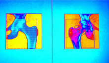 bone density scan