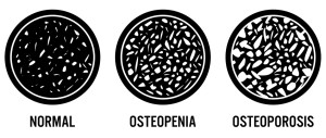 osteoporosis dxa scan