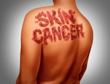 can you die from skin cancer?