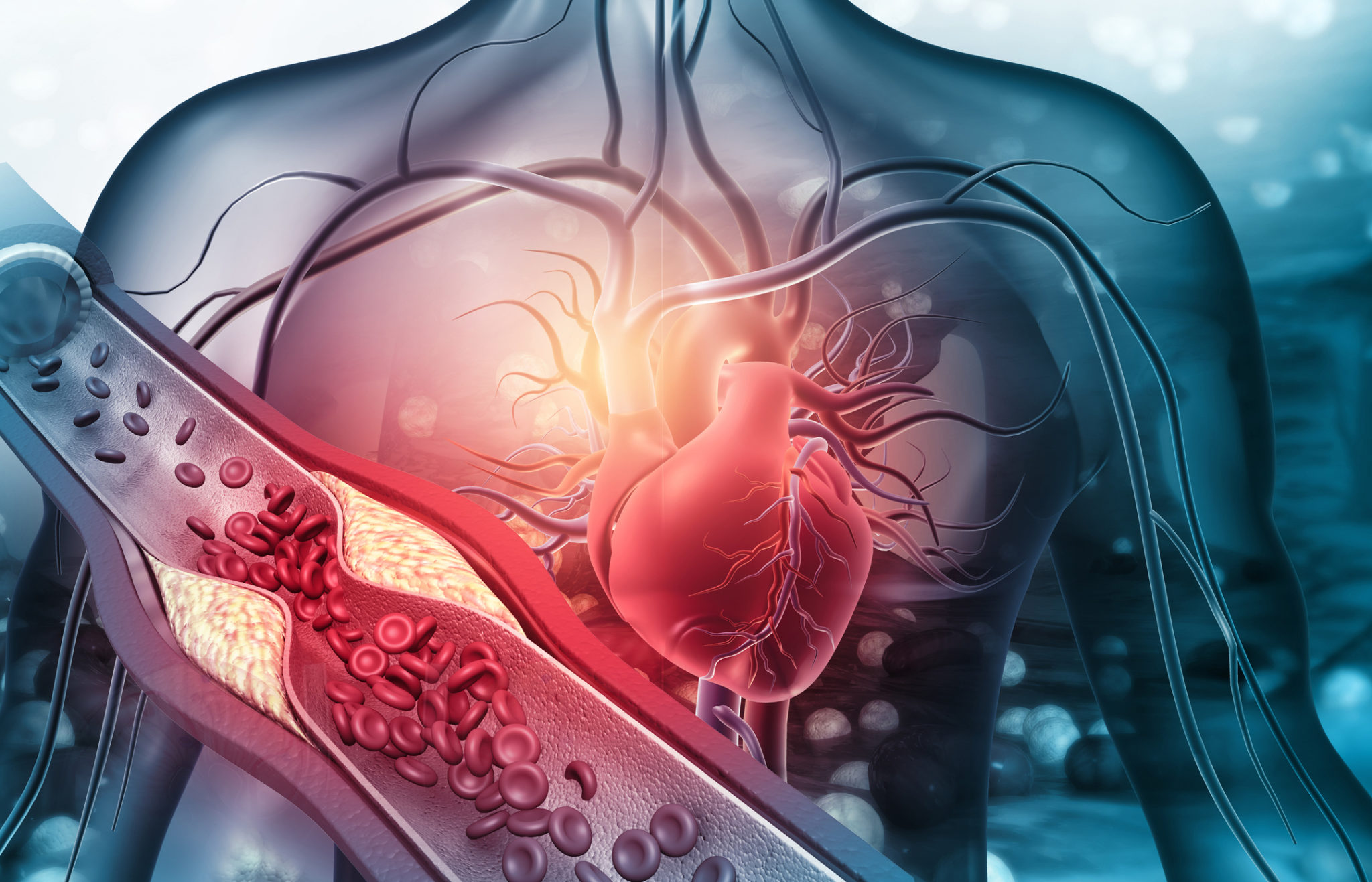 reversing-atherosclerosis-plaque-buildup