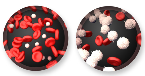 leukemia symptoms