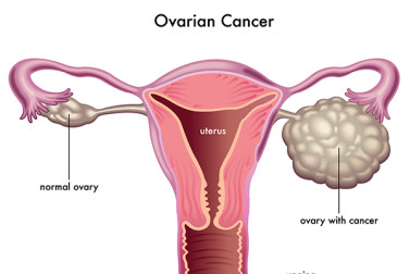 ovarian cancer symptoms