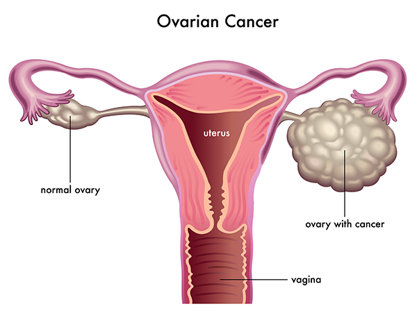 ovarian cancer symptoms