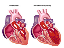 enlarged heart