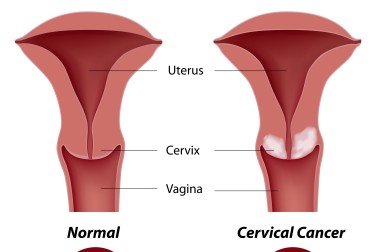 Cervical cancer