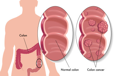 bowel cancer screening