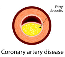 coronary artery disease