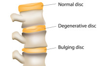 degenerative disc pain