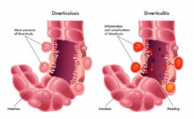 diverticulitis diet