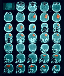 hemorrhagic stroke