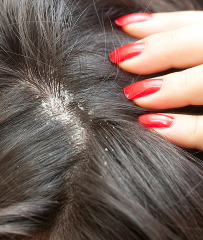 Head of hair suffering from dandruff