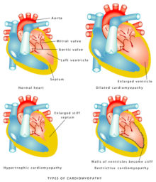 what is cardiomyopathy