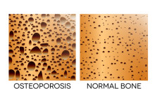 understanding t score bone density - osteoporosis vs normal bone