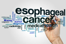 esophageal cancer