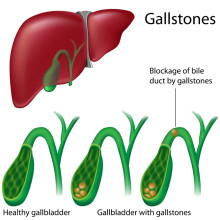 gallbladder attack symptoms