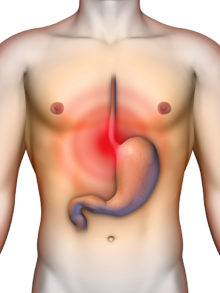 gastrointestinal reflux disease symptoms