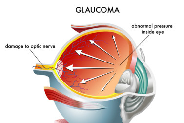 glaucoma symptoms