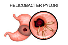 H. pylori natural treatment