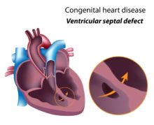 what is a heart murmur