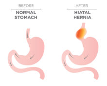 hiatal hernia pain relief