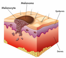 melanomas