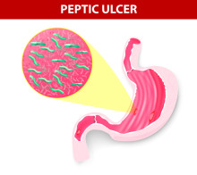 ulcer symptoms