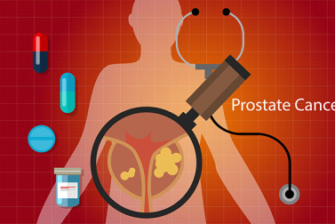 prostate cancer stages