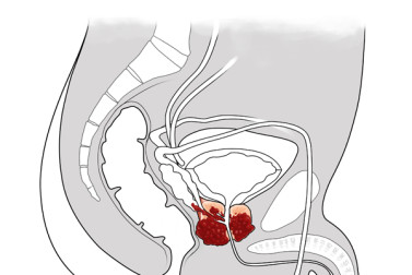 Illustration of prostate