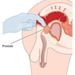 digital rectal exam