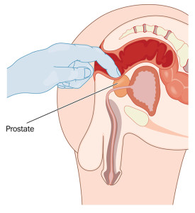 digital rectal exam