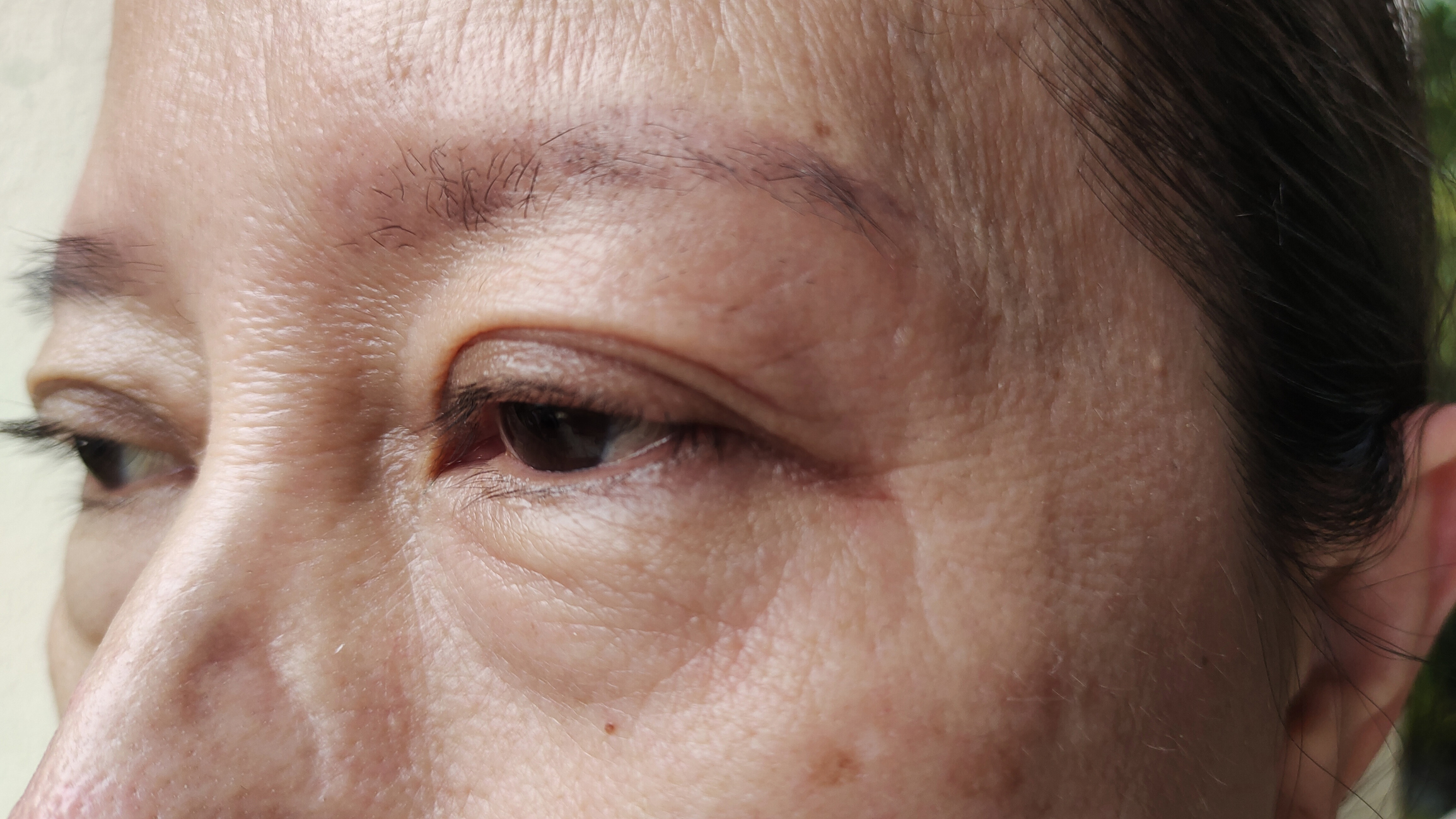 ptosis woman with droopy eyelid