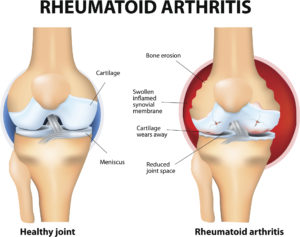 rheumatoid arthritis vs normal joints