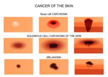 skin cancer types