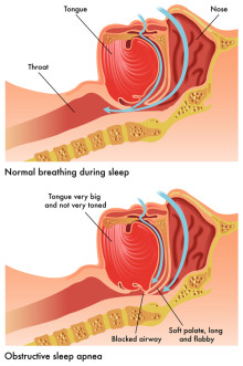 sleep apnea symptoms