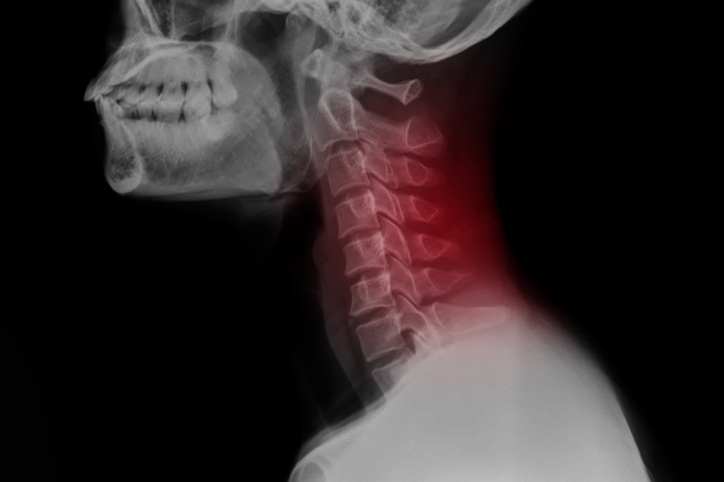 spinal xray