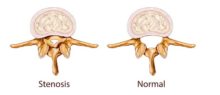 what is spinal stenosis