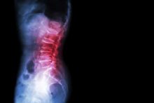 spondylosis