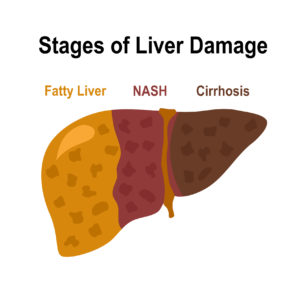 stages of nonalcoholic fatty liver disease