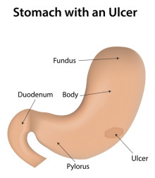 stomach ulcer symptoms