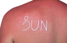 sunburn relief