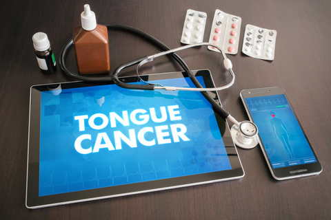 tongue cancer