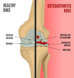 turmeric for osteoarthritis