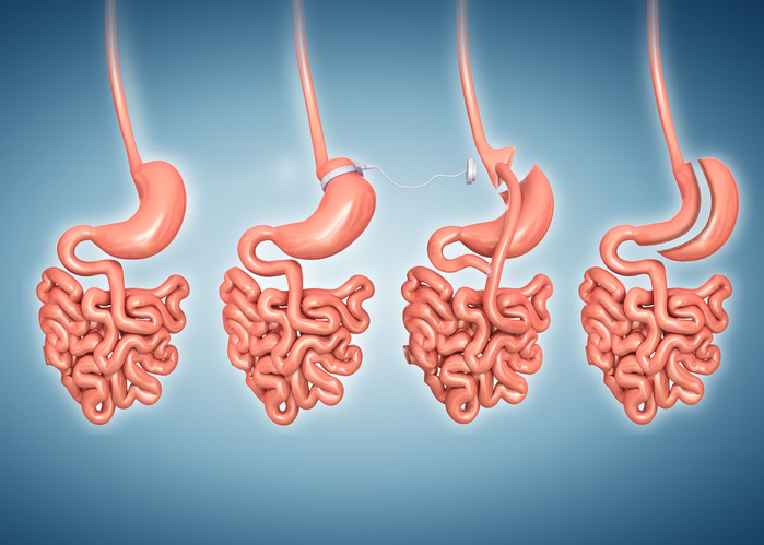 types of bariatric surgery